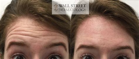 With the prevalence of botox injections for crow's feet as a gauge, results from this outpatient procedure are relatively quick and successful. Natural-Looking Botox Treatment in NYC - Wall Street ...