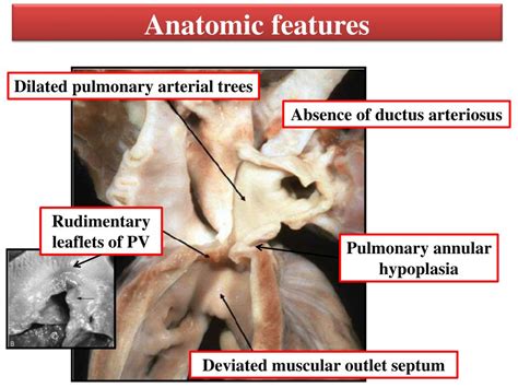 Polymorphisms in the methylenetetrahydrofolate reductase gene and the vegf gene have been linked to an increased risk of tof from two recent studies. PPT - Anatomy and pathophysiology of tetralogy of Fallot ...