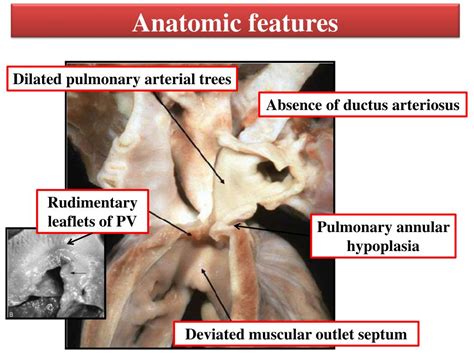 Pathophysiology in pediatric patients with tetralogy of fallot. PPT - Anatomy and pathophysiology of tetralogy of Fallot ...