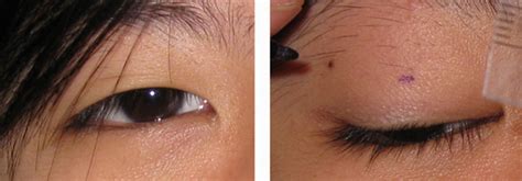 Double eyelid surgery will make your appearance look younger and give your eyes and face more volume and depth. 双眼皮手术在大马 by 蔡鐘能眼科教授