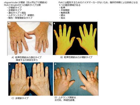 乾癬性関節炎 NEJM2017を読んでみる | まきむく通信(どうでもいい ...