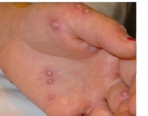 Between 1970 and 1986, over 400 cases in humans were reported. Trivia! - Monkey Pox 4 Dummies!