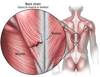 The trapezius is the most superficial muscle of the back and forms a broad flat triangle. Pulled Back Treatment in NJ | Pain Management Doctor ...