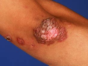 Бородавчатый туберкулез кожи (tuberculosis verrucosa cutis). Cutaneous tuberculosis | DermNet NZ