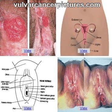 Learn more about the types, symptoms, causes, risk factors, stages, diagnosis, treatment, and prognosis of vaginal cancer. health 4 all: Vulvar Cancer