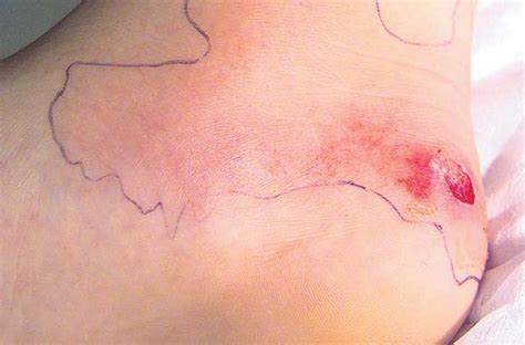 Here are some of the signs and symptoms associated with a blister that is infected: image006