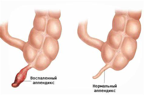 Symptoms of appendicitis: how to recognize appendicitis in time? Картинка - Symptoms of appendicitis: how to recognize appendicitis in time?