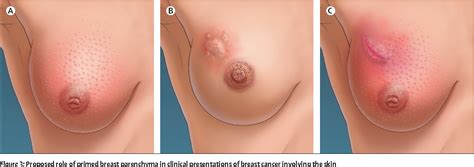 The following early signs and symptoms of breast cancer can happen with other conditions that are not cancer related. Inflammatory breast cancer: unique biological and ...