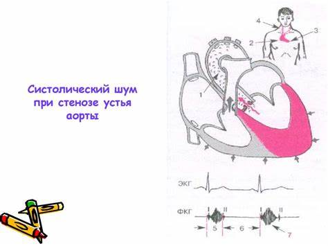 Диета при стенозе устья аорты Аускультация сердца: тоны и шумы - презентация онлайн Аускультация сердца: тоны и шумы - презентация онлайн Диета при стенозе устья аорты