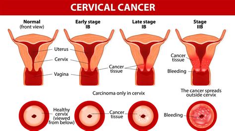 The first identifiable symptoms of the disease are likely to include: Cervical Cancer Causes, Symptoms & Signs, Treatment