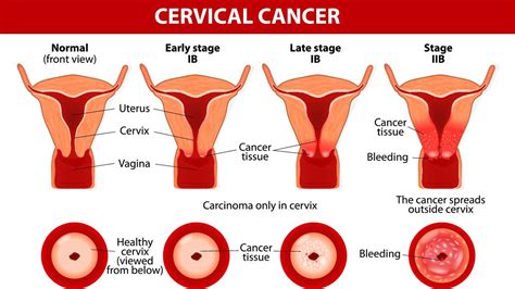 Cervical cancer is a type of cancer that develops in a woman's cervix (the entrance to the womb from the vagina). Cervical Cancer Causes, Symptoms & Signs, Treatment