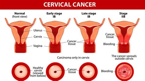 Feeling full too quickly or difficulty eating, bloating, and abdominal or back pain are common only for ovarian cancer. Cervical Cancer Causes, Symptoms & Signs, Treatment