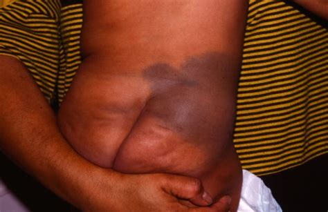 However, there have been reports of mongolian spot being associated with other pediatric conditions. Mongolian Spot, Birthmark, On White Baby, Do Mongolian ...