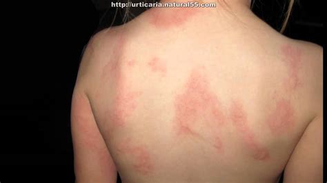 And viral infections , like measles, can also result in rashes. Home Treatment For Hives Allergy In Adults & Children ...