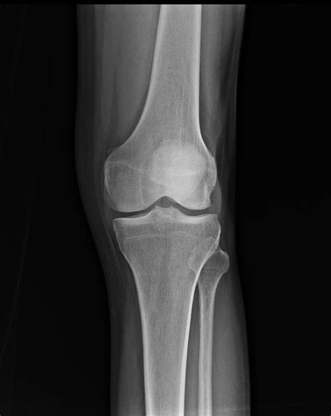 Is the presence of a radiological finding of calcification on the medial side of the knee as a consequence. Pellegrini Stieda lesion | Image | Radiopaedia.org