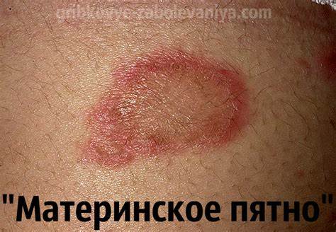 Лишай диета розовый жибера Розовый лишай Жибера: причины, симптомы, лечение, фото Розовый лишай Жибера: причины, симптомы, лечение, фото Лишай диета розовый жибера