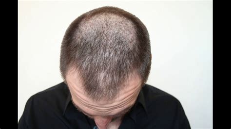 Minoxidil will not be able to affect frontal areas that have gone completely bald. How Does Minoxidil Work For Male Pattern Baldness - How To ...