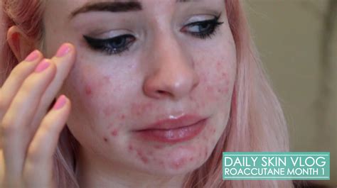 Hopefully only 2 more weeks and the purge will be over! INTRODUCTION TO MY ROACCUTANE JOURNEY - Katie Snooks