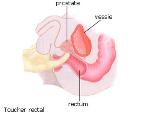 L'apparition d'un cancer de la prostate correspond à la transformation des cellules de la prostate. Maladies de la Prostate