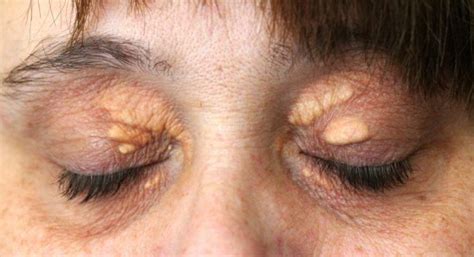 How to get rid of white bumps under my eyes? Pin on How to Remove the Cholesterol Deposits Around Your ...