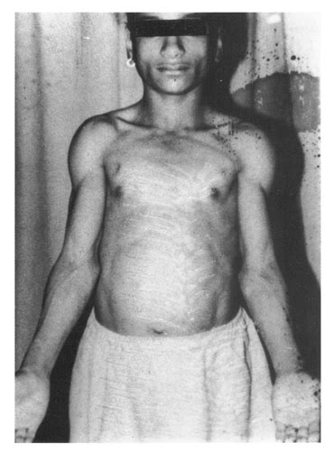 Get the complete information in our medical search engine for phen. Seip-Berardinelli Lipodystrophy: Report of Three Cases and ...