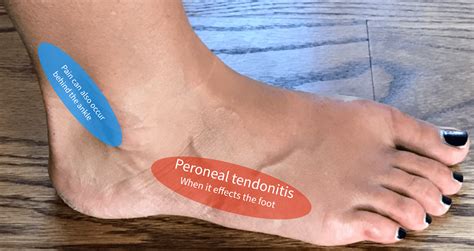 The appearance of the skin layer is determined based on the underlying layers. Peroneal Tendonitis - Almawi Limited The Holistic Clinic