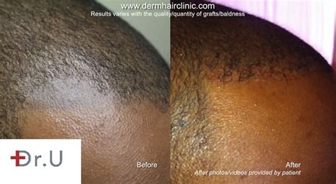 FUE Hair Transplant Repairs Bad Scalp Micropigmentation ...