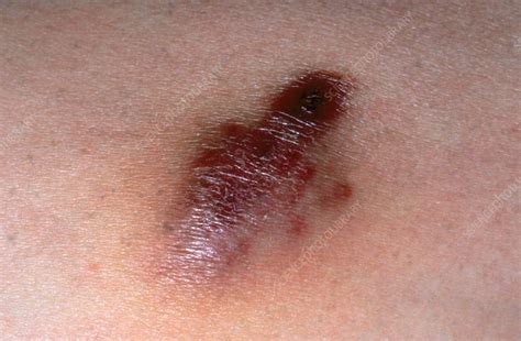 Lesions can occur singly, multiply in a limited area, or may be widespread. Kaposi's Sarcoma - Stock Image - C003/1313 - Science Photo ...