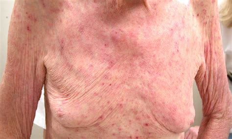 Learn when and how to isolate. Scabies