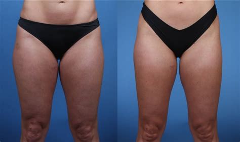 Tumescent liposuction + inner thighs. Liposuction Blog: Liposuction. Lower Abdomen, Inner Thighs ...