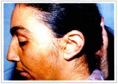 RBCP - Microsurgical Reimplantation of Total Scalp ...