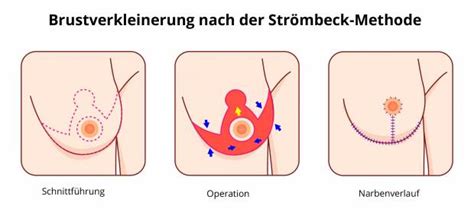Und auch in vielen chirurgischen standardlehrbüchern heißt es: Brustverkleinerung - Brustoperation ...