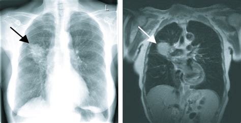 Launch metal detector, body scanner and start to move the device around. Chest MRI. Causes, symptoms, treatment Chest MRI