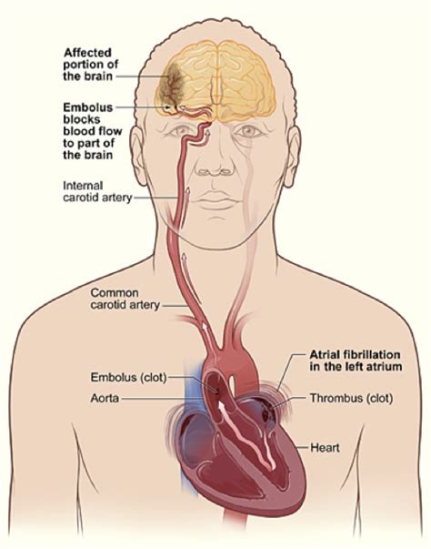 In his first season with the stroke it cast, the team's most senior member provided the veteran. Dr. Pat Consults: The Anatomy of a Stroke | Women's Voices ...