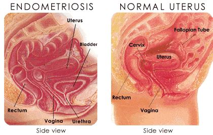 It is possible since i had adenomyosis i could also have endometriosis. Endometriosis: Síntomas, causas y tratamiento - Embarazo10.com