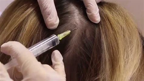 , calcium pantothenate ,niacinamide with minerals) and acnestar ( clindamycin & nicotinamide. mesotherapy of scalp in hair loss - YouTube