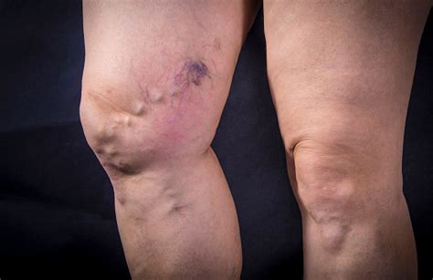 Varicose veins are not considered a serious medical condition. Varicose Veins Stock Photo - Download Image Now - iStock