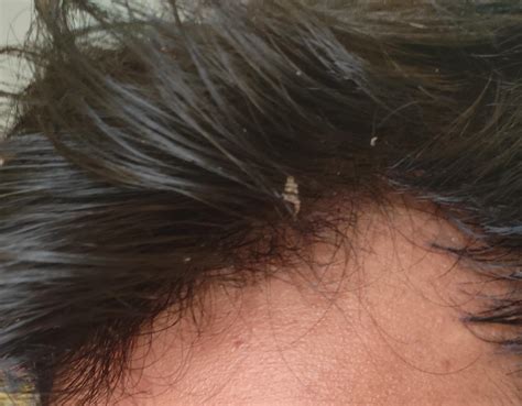 Suffering from these kind of patches along the receding hairline. Any ...