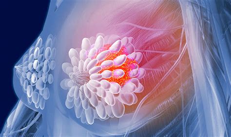 Mastitis, an infection of the breast, is often accompanied by redness, swelling, and pain. Cancer symptoms: Signs of breast tumour include lumps ...