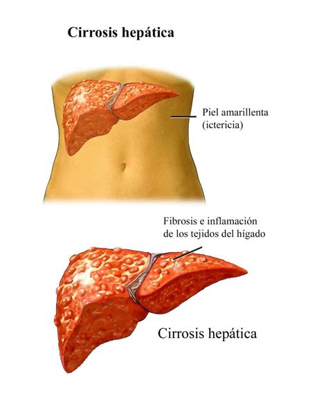 Fomentar el deporte y los buenos valores a la juventud. Hepatitis C, tratamiento y medicamentos, nuevo, interferón ...