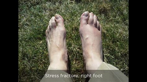 Stress fractures can occur to any bone in our bodies, but our feet are the most common location. Stress fracture, metatarsal area, right foot - YouTube