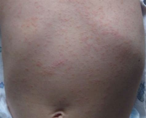 How long do coronavirus antibodies actually last? Roseola Rash - Pictures, Symptoms, Causes, Treatment, Home ...