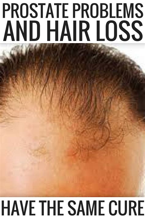 You may need to take it for several months or years. prostate problems and hair loss have the same cure, hair ...