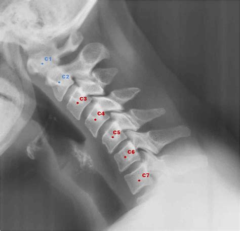 The transverse processes of all cervical vertebrae have an opening of the transverse process (foramen processus transversus). Template Matching Approaches Applied to Vertebra Detection ...