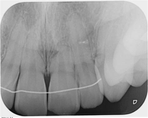 Is this tooth resorption? | Dentistry Forums