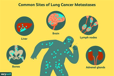 If your dog is diagnosed with lung cancer due to an immediate respiratory crisis as a result of the cancer, their prognosis is poor. Journal of Gastrointestinal and Liver Diseases Metastatic ...