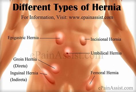 Here are some helpful things to know about different types referred pain is pain felt in parts of the body other than the anatomical cause. 4 Key Qualities That You Want With Hernia Support Briefs ...