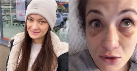 Karolina kowalkiewicz reacts to her eye injury following fight with yan xiaonan at ufc auckland via report here if this video is not working. Karolina Kowalkiewicz Needs Titanium Plate For Broken Face ...