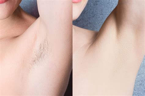 While both these procedures are performed to inhibit unwanted hair growth, they are far from being interchangeable. Laser Hair Removal VS Electrolysis Hair Removal: Which is ...