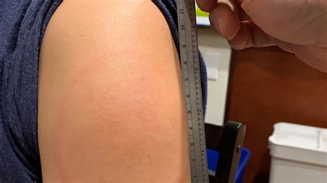 Food and drug administration issued an emergency use authorization (eua) for the second vaccine for. 'COVID arm': Moderna vaccine rash a harmless side effect ...